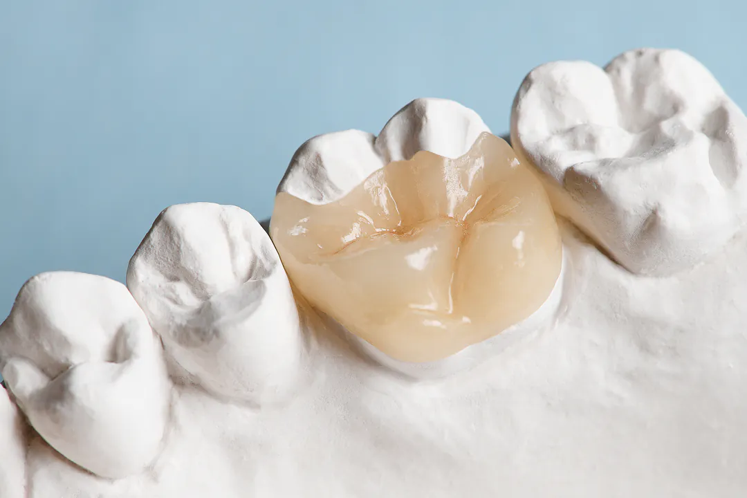 詰め物・被せ物のイメージ